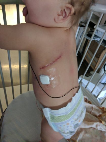 The thoracotomy incision, easily visible as he insisted on pulling himself up to standing less than a day after the surgery.